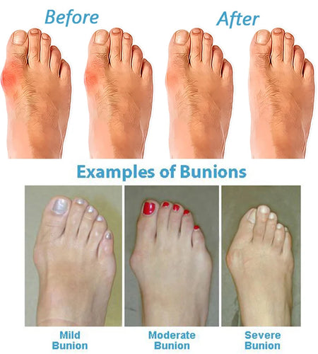 Women Sandals Casual Flip-flops Summer Shoes Woman Wedges Sandals Platform Heels Sandalias Mujer Big Toe Foot Correction Sandals